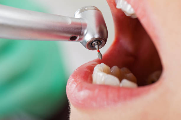 Best Emergency Tooth Extraction in Centreville, MD